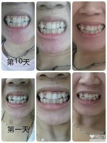 国产透明牙套矫正视频,见证微笑蜕变之旅